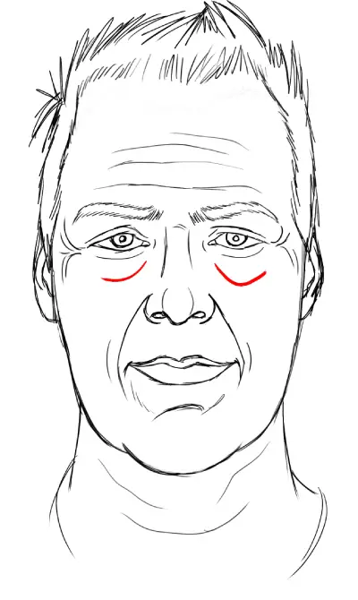 drawing tear troughs on a face